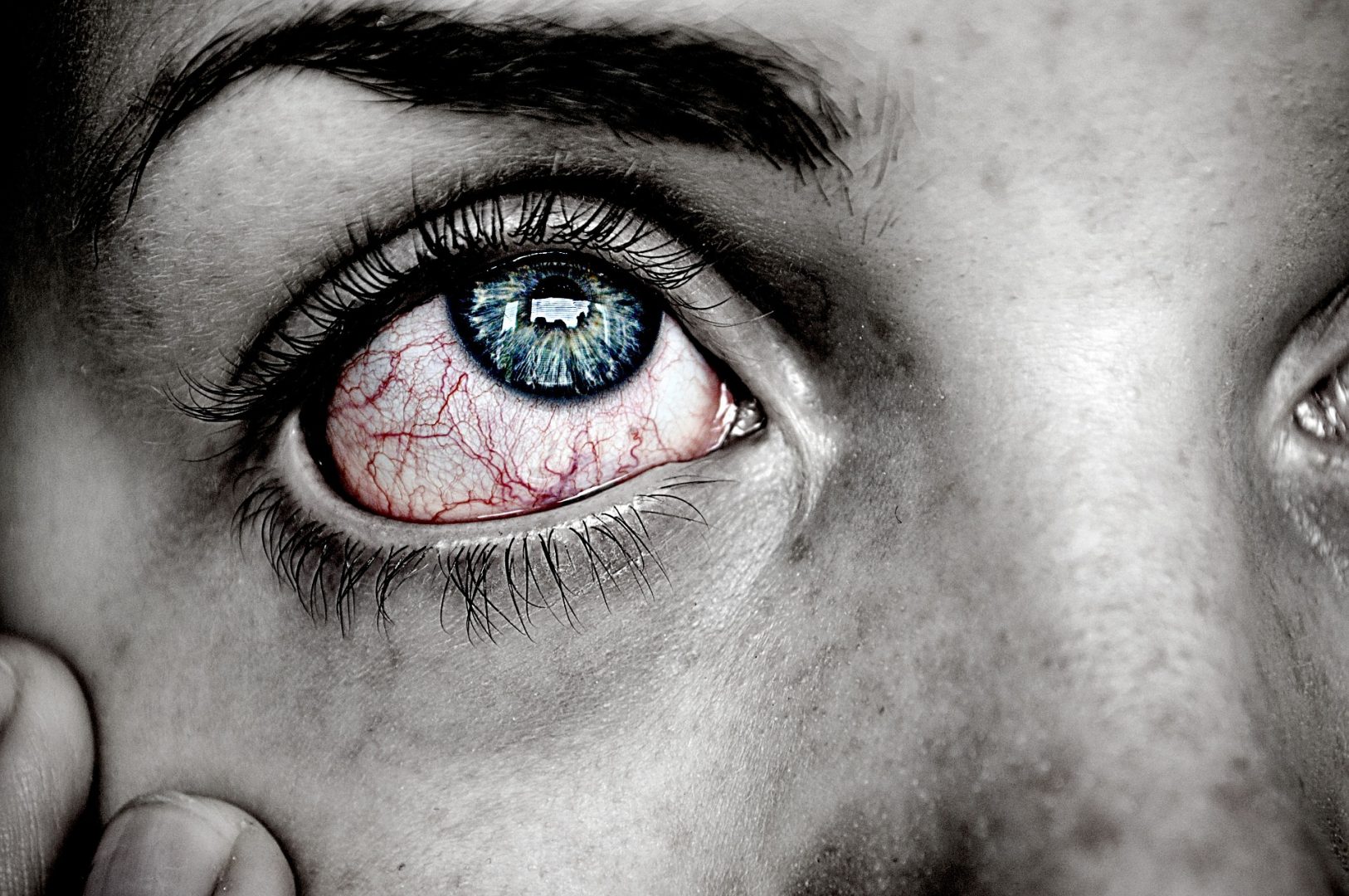 Infecção no olho: 6 cuidados para evitá-la