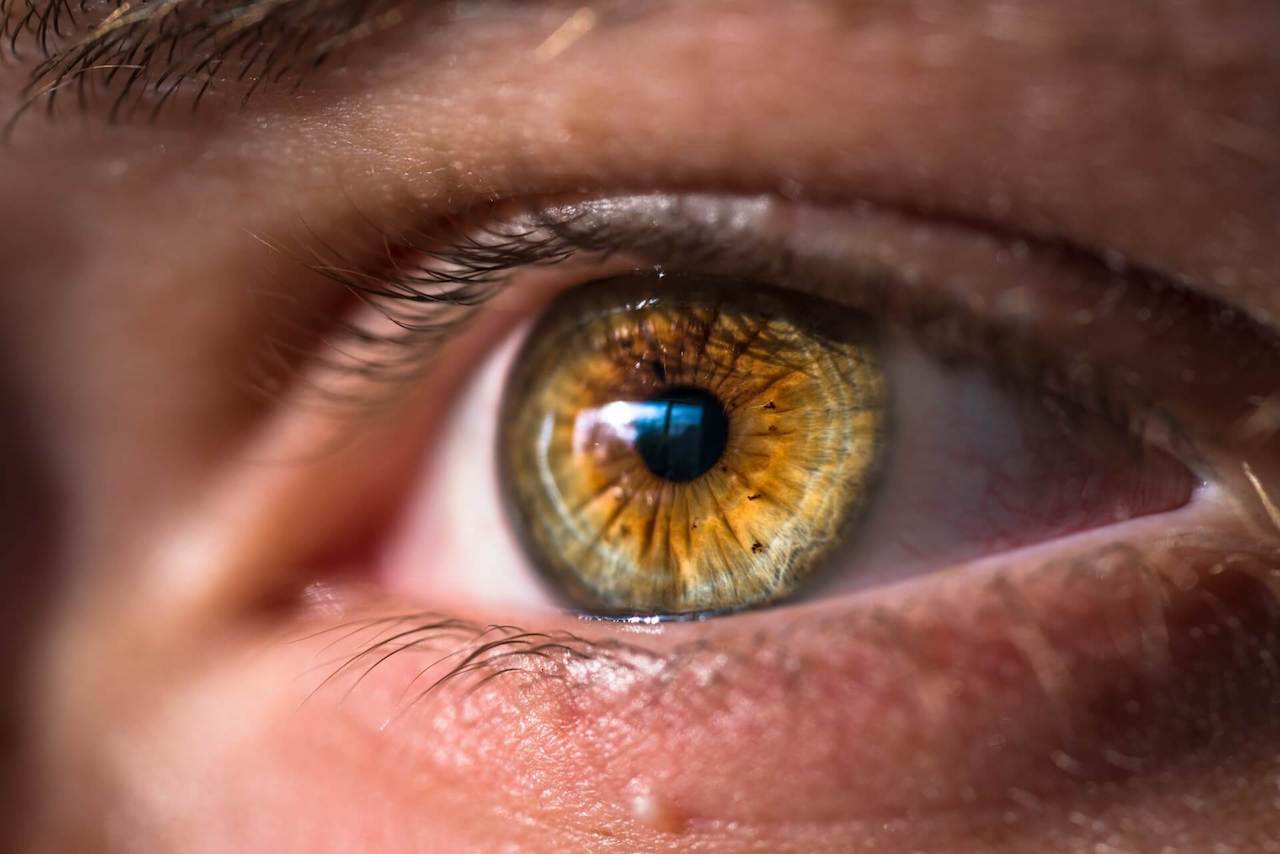 Espinha no olho: o que é e como evitar?